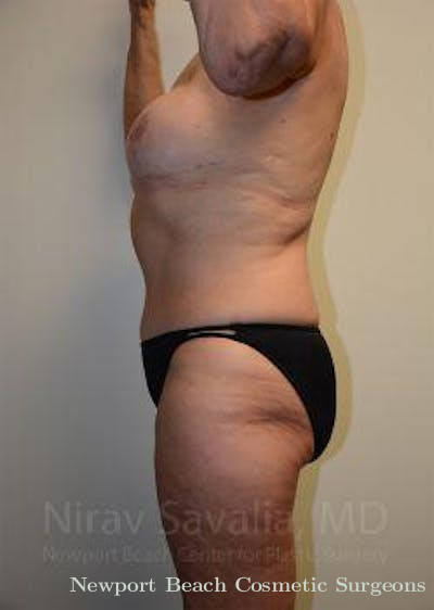 Abdominoplasty Tummy Tuck Before & After Gallery - Patient 1655634 - After
