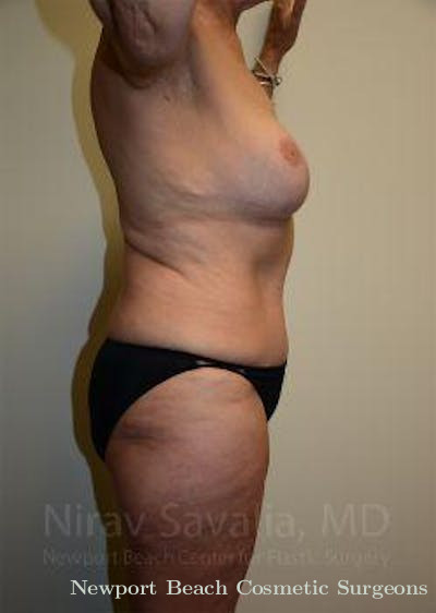 Mastectomy Reconstruction Revision Before & After Gallery - Patient 1655634 - After