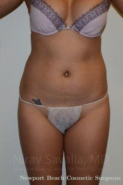 Liposuction Before & After Gallery - Patient 1655637 - Before