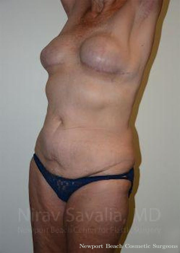 Mastectomy Reconstruction Revision Before & After Gallery - Patient 1655634 - Before