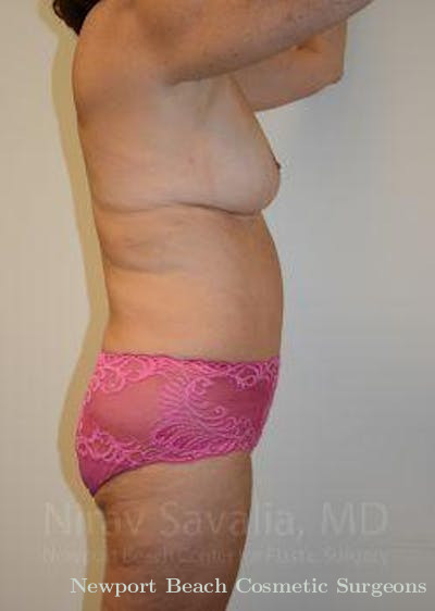 Body Contouring after Weight Loss Before & After Gallery - Patient 1655635 - After