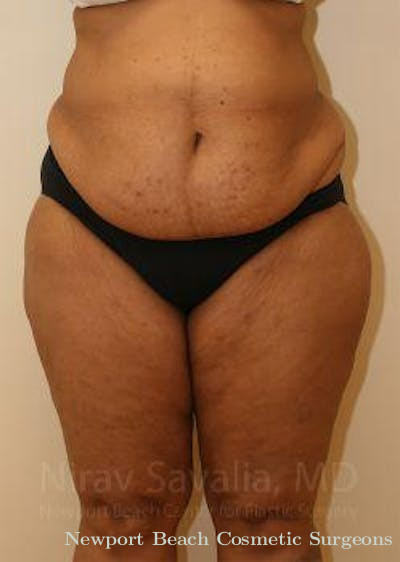 Body Contouring after Weight Loss Before & After Gallery - Patient 1655636 - Before