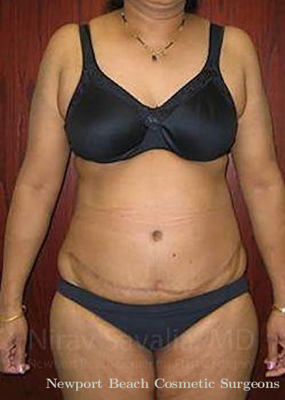 Abdominoplasty Tummy Tuck Before & After Gallery - Patient 1655636 - After