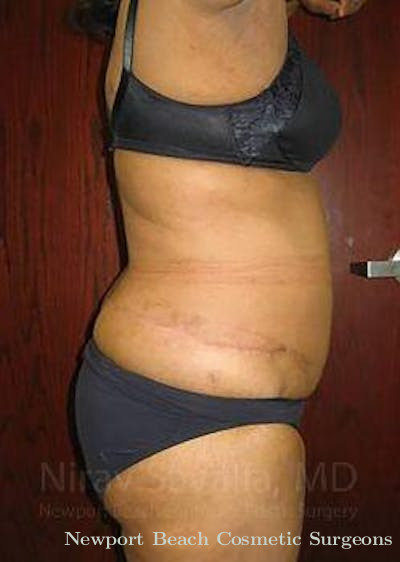 Body Contouring after Weight Loss Before & After Gallery - Patient 1655636 - After