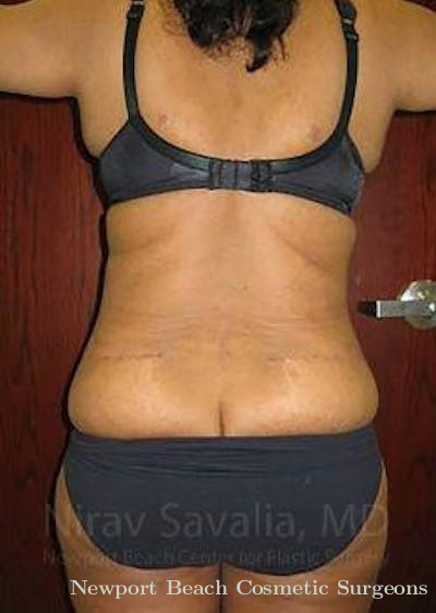 Breast Reduction Before & After Gallery - Patient 1655636 - After