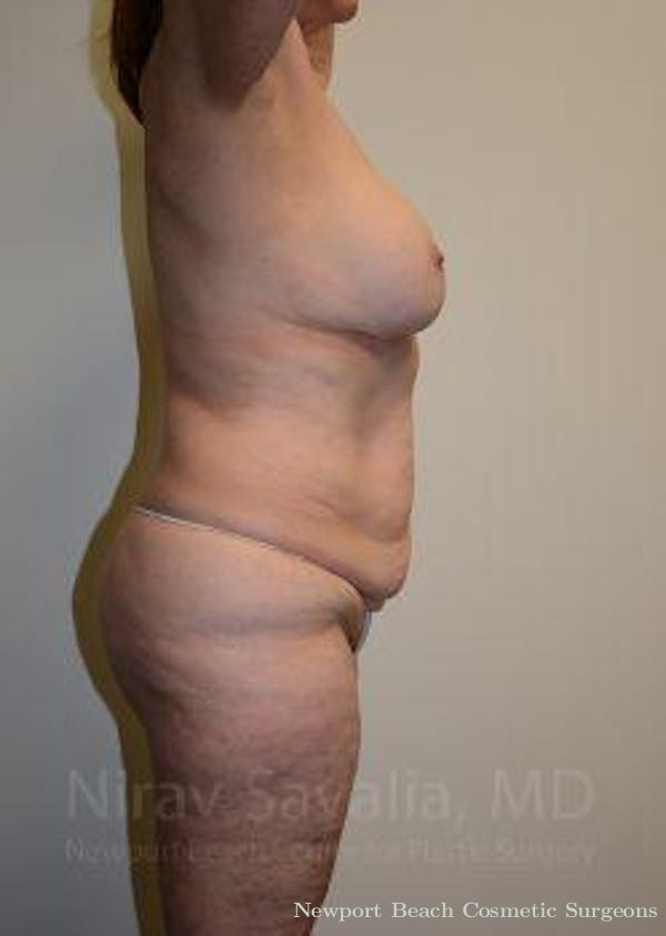 Thigh Lift Before & After Gallery - Patient 1655639 - Before