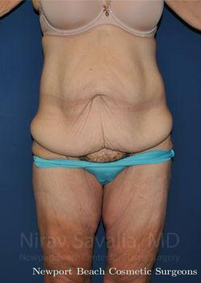 Liposuction Before & After Gallery - Patient 1655640 - Before