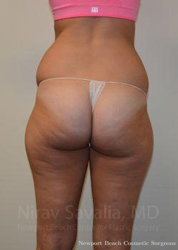 Breast Reduction Before & After Gallery - Patient 1655642 - Before