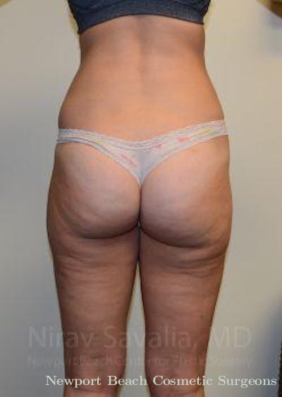 Thigh Lift Before & After Gallery - Patient 1655642 - After