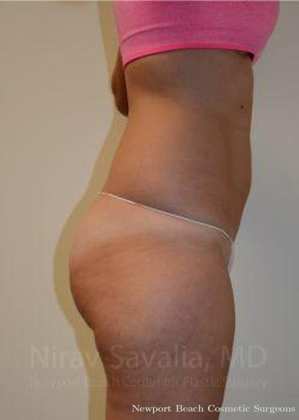 Breast Augmentation Before & After Gallery - Patient 1655642 - Before