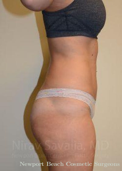 Mastectomy Reconstruction Revision Before & After Gallery - Patient 1655642 - After