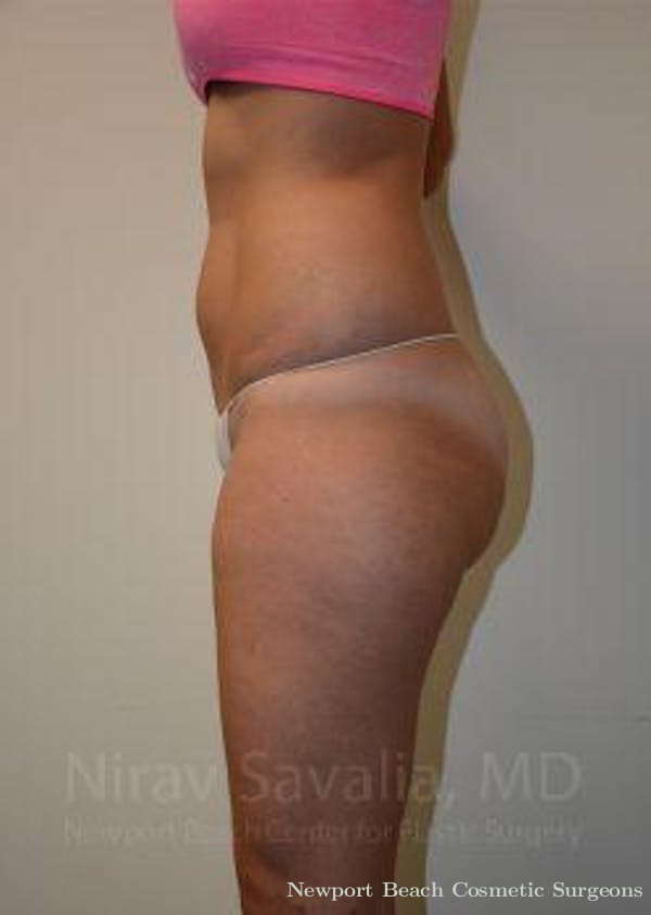 Oncoplastic Reconstruction Before & After Gallery - Patient 1655642 - Before
