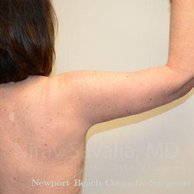 Mastectomy Reconstruction Revision Before & After Gallery - Patient 1655643 - After