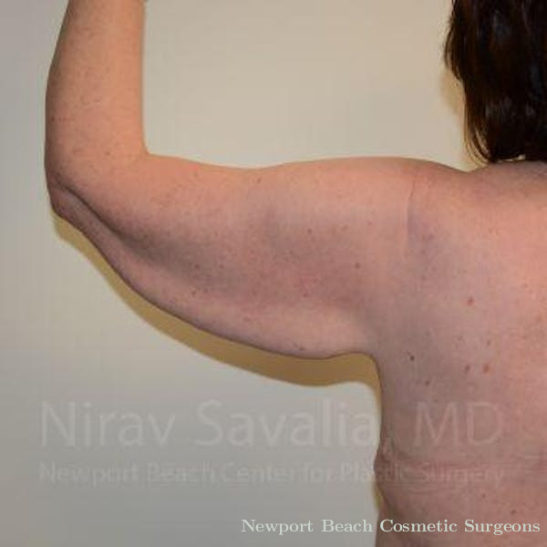 Mastectomy Reconstruction Revision Before & After Gallery - Patient 1655643 - Before