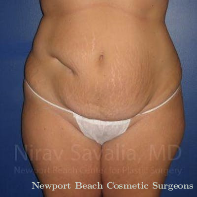 Mastectomy Reconstruction Revision Before & After Gallery - Patient 1655647 - Before