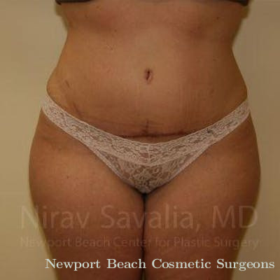Breast Lift without Implants Before & After Gallery - Patient 1655647 - After