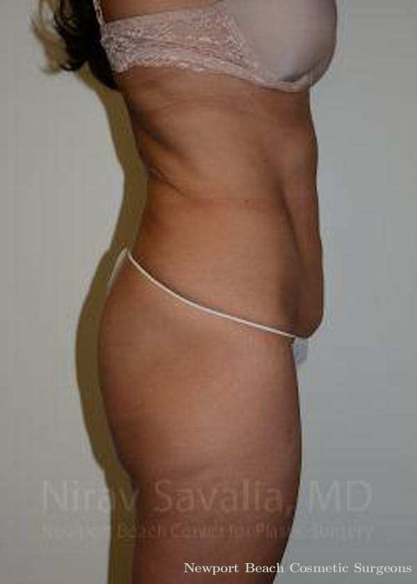 Breast Implant Revision Before & After Gallery - Patient 1655645 - Before