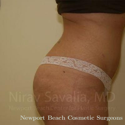 Liposuction Before & After Gallery - Patient 1655647 - After