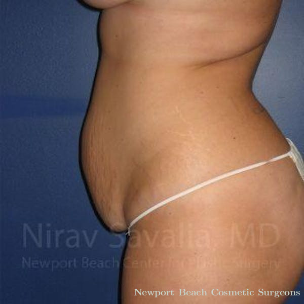 Body Contouring after Weight Loss Before & After Gallery - Patient 1655647 - Before