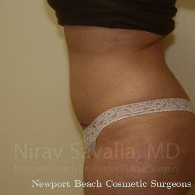 Mastectomy Reconstruction Revision Before & After Gallery - Patient 1655647 - After