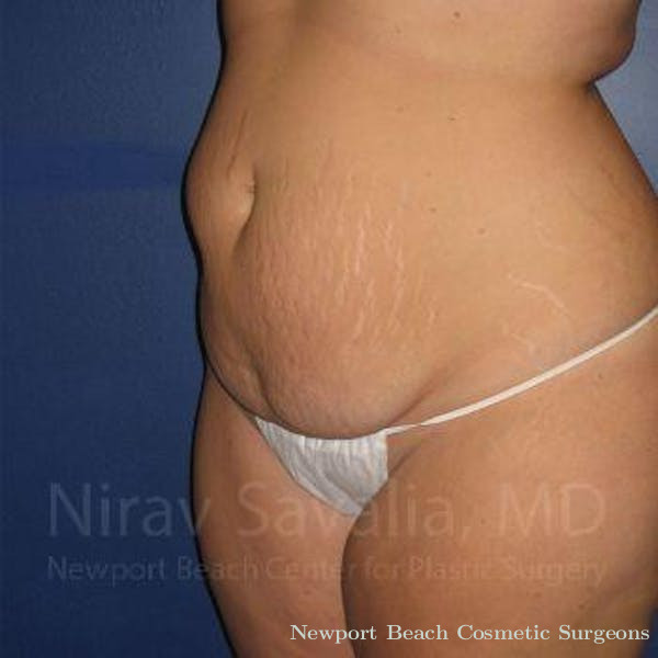 Mastectomy Reconstruction Revision Before & After Gallery - Patient 1655647 - Before