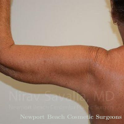 Arm Lift Before & After Gallery - Patient 1655646 - After