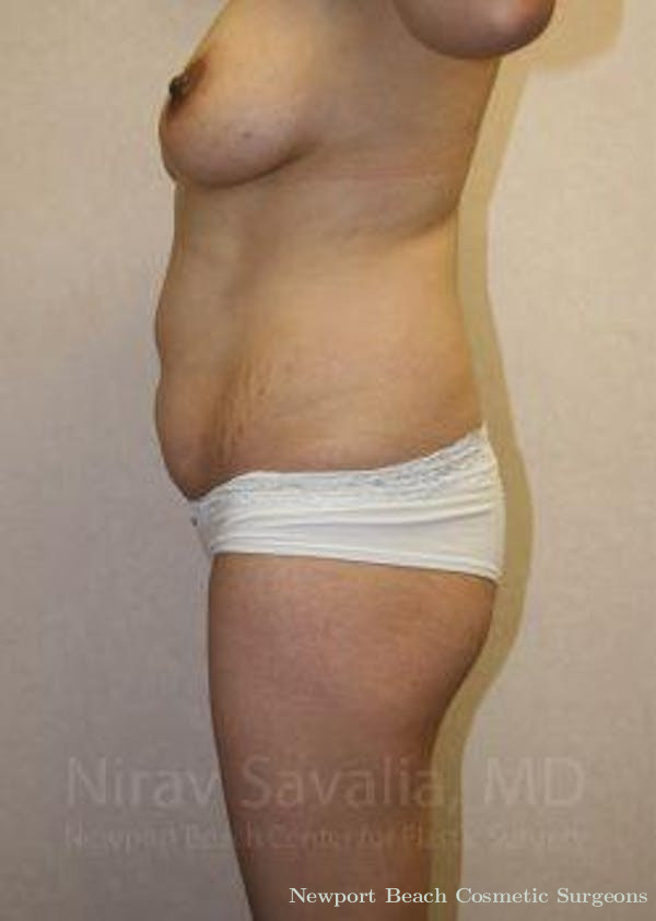 Breast Explantation En Bloc Capsulectomy Before & After Gallery - Patient 1655648 - Before