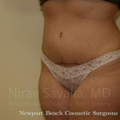 Breast Explantation En Bloc Capsulectomy Before & After Gallery - Patient 1655647 - After