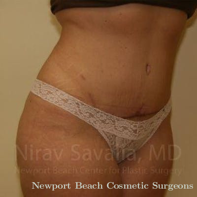 Mastectomy Reconstruction Before & After Gallery - Patient 1655647 - After