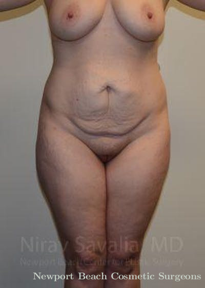 Mastectomy Reconstruction Revision Before & After Gallery - Patient 1655652 - Before