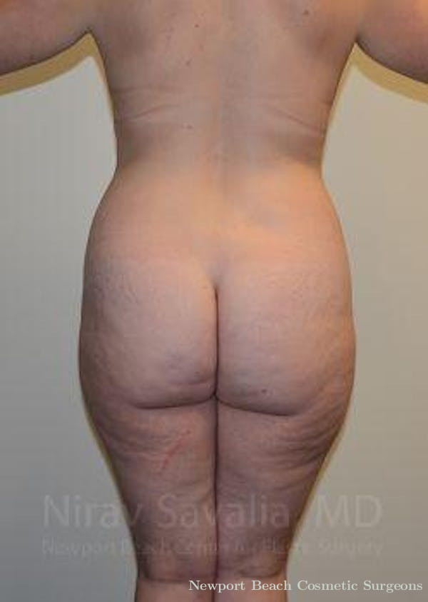 Oncoplastic Reconstruction Before & After Gallery - Patient 1655652 - Before