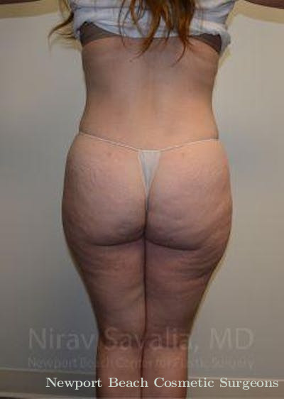 Mastectomy Reconstruction Revision Before & After Gallery - Patient 1655652 - After