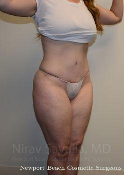 Male Breast Reduction Before & After Gallery - Patient 1655652 - After