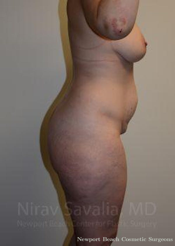 Breast Explantation En Bloc Capsulectomy Before & After Gallery - Patient 1655652 - Before