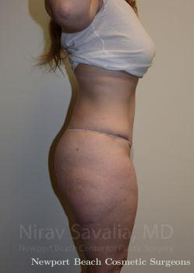 Thigh Lift Before & After Gallery - Patient 1655652 - After