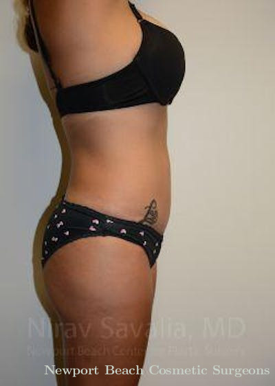 Breast Reduction Before & After Gallery - Patient 1655653 - After