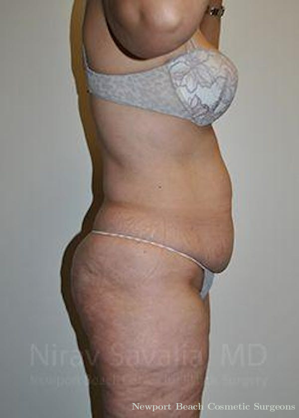 Mastectomy Reconstruction Revision Before & After Gallery - Patient 1655654 - Before