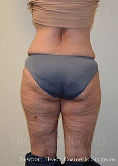 Thigh Lift Before & After Gallery - Patient 1655654 - After