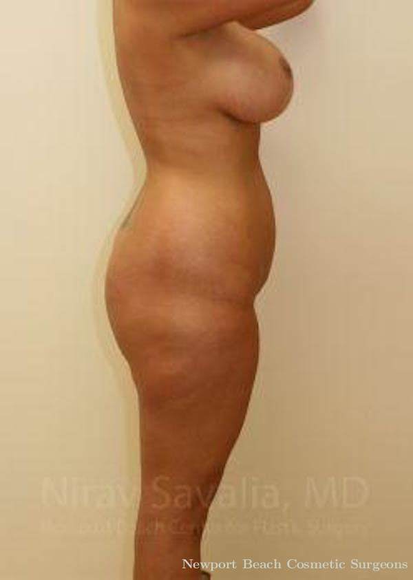 Mastectomy Reconstruction Revision Before & After Gallery - Patient 1655656 - Before