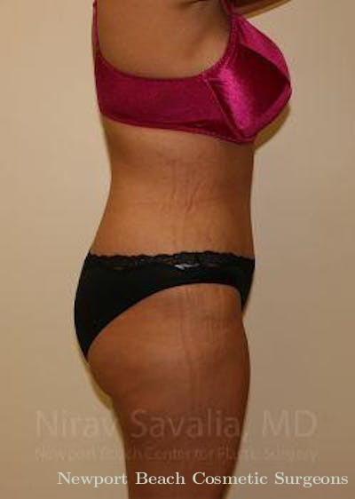 Mastectomy Reconstruction Before & After Gallery - Patient 1655656 - After