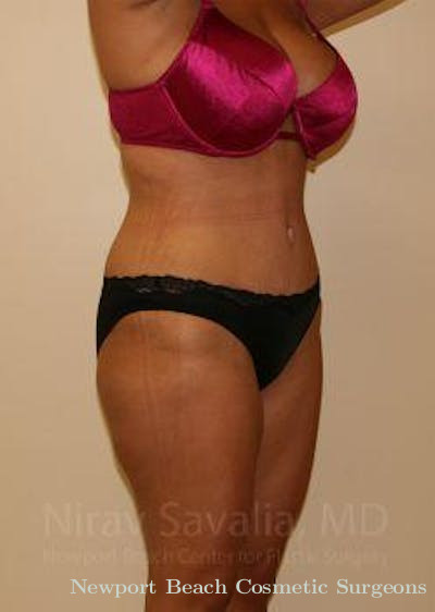 Body Contouring after Weight Loss Before & After Gallery - Patient 1655656 - After