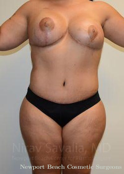 Breast Implant Revision Before & After Gallery - Patient 1655657 - After