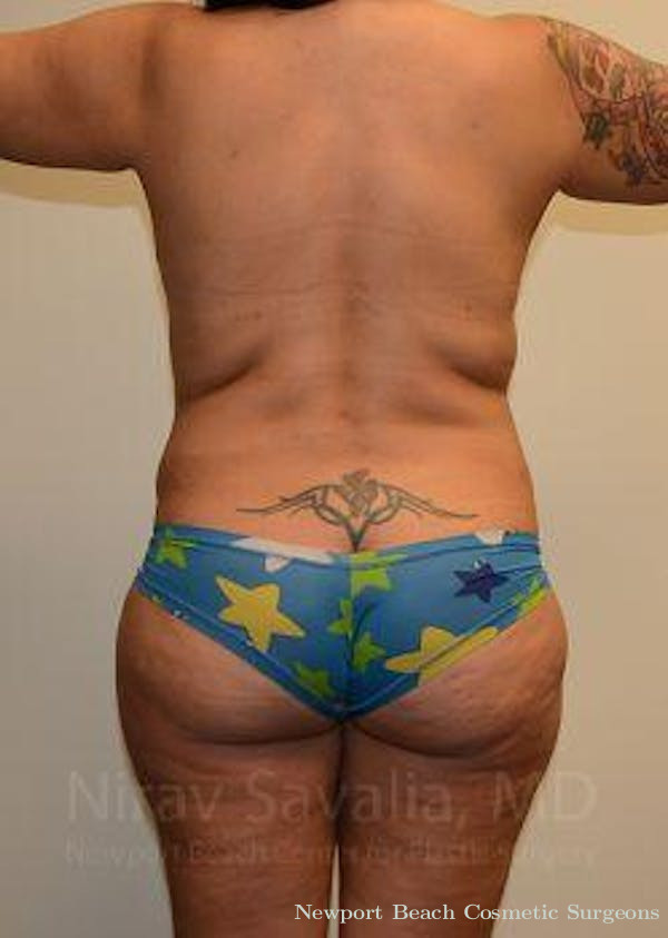 Liposuction Before & After Gallery - Patient 1655657 - Before