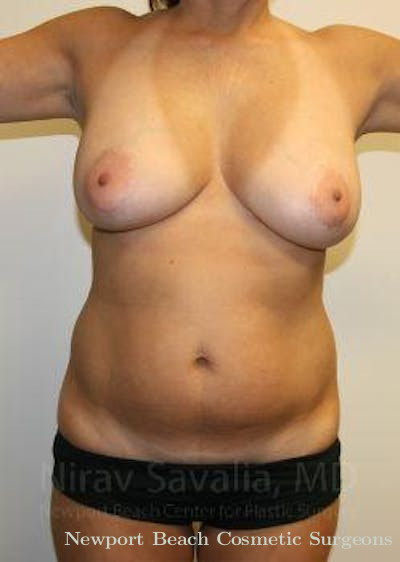 Breast Explantation En Bloc Capsulectomy Before & After Gallery - Patient 1655658 - Before