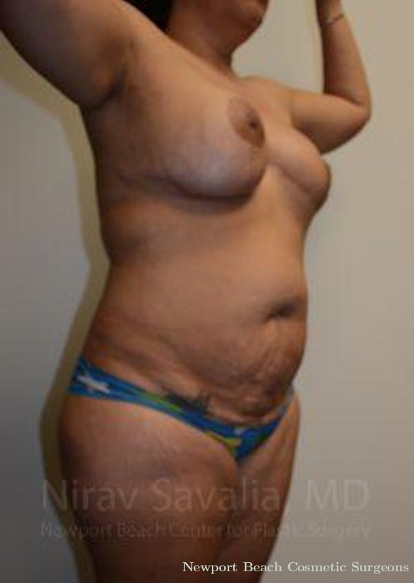 Oncoplastic Reconstruction Before & After Gallery - Patient 1655657 - Before
