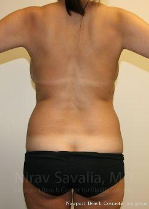 Body Contouring after Weight Loss Before & After Gallery - Patient 1655658 - Before