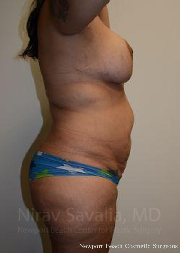 Oncoplastic Reconstruction Before & After Gallery - Patient 1655657 - Before