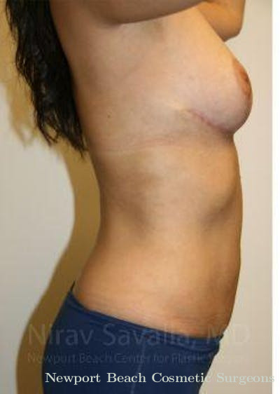 Mastectomy Reconstruction Revision Before & After Gallery - Patient 1655658 - After