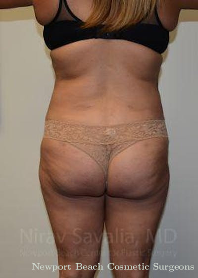 Mastectomy Reconstruction Revision Before & After Gallery - Patient 1655659 - After