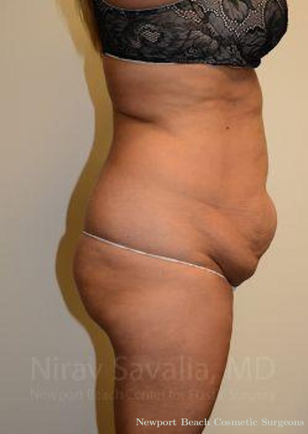 Mastectomy Reconstruction Revision Before & After Gallery - Patient 1655659 - Before